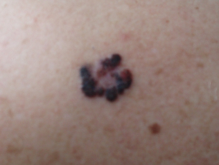 melanoom-staadium-IB