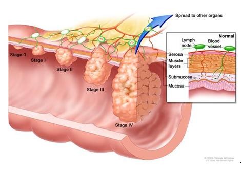 soolevähi-staadiumid