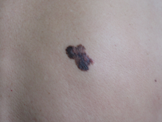 меланом-стадия-IA