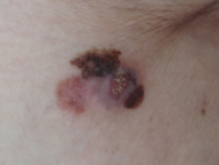 меланом-стадия-IIA